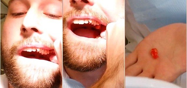 un-étudiant-sextrait-lui-même-une-dent-de-sagesse-636x300