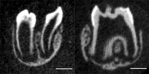 Coupes tomographiques dents dédoublées