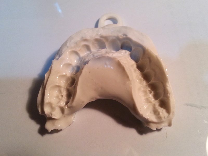 Empreinte en alginate amos dudley