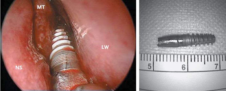 implant-dentaire-dans-les-sinus